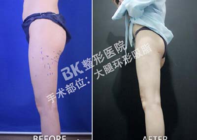 韩国BK整形外科大腿吸脂前后照片