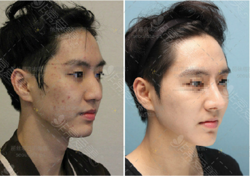 男生去韩国整鼻子需要多少钱？韩国鼻修复价格曝光！