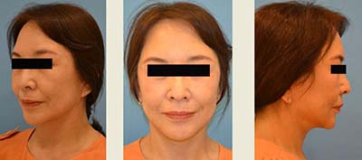 日本铃木芳郎院长面部拉皮手术术后三个月照片
