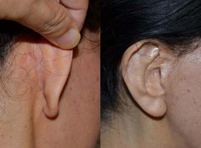 铃木芳郎拉皮术后耳部疤痕示意图