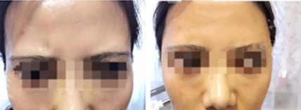 颞部填充一定减龄吗？纯真医院用真人日记告诉你答案