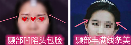 颞部填充一定减龄吗？纯真医院用真人日记告诉你答案