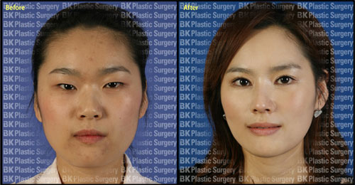 韩国bk整形切开法双眼皮术前术后对比图