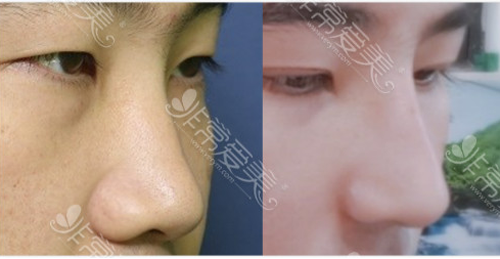 韩国Glory医院修复挛缩鼻子效果如何？鼻子一直缩如何修复?