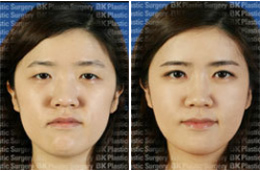韩国bk医院眼部整形手术前后对比图