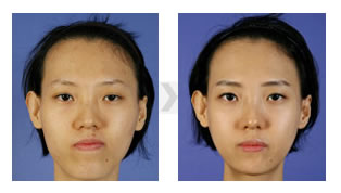 韩国BK整形外科双鄂整形前后对比照片