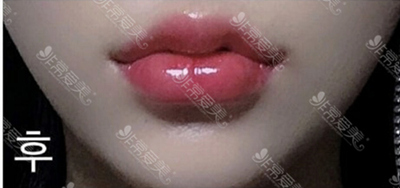 韩国dressps整形外科唇部整形效果图