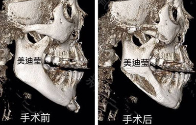 韩国美迪莹整形外科下颌角手术真实CT图展示