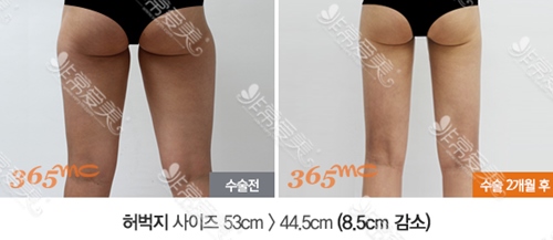 吸脂大腿能瘦多少厘米