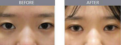 韩国延世mini整形医院眼部手术照片