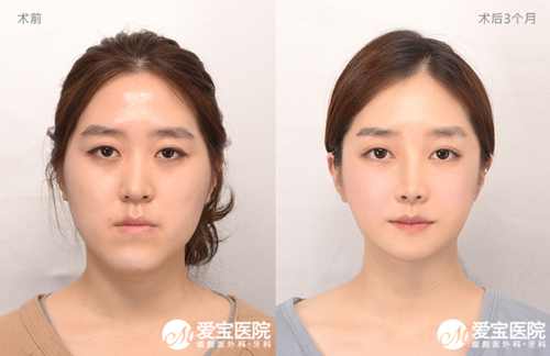 韩国爱宝（Everm）整形医院双鄂手术案例对比图