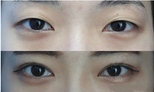韩国网红都切的什么双眼皮，哪家医院做得好？