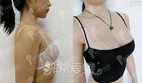 韩国普罗菲尔假体隆胸对比图