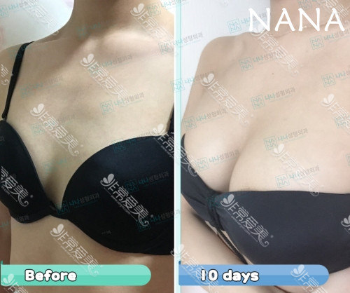 韩国NANA假体隆胸前后对比