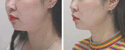 韩国摩兹(MODS)整形医院瘦脸针注射照片