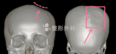 韩国H白汀桓医院从颅骨采集自体骨材料