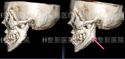 韩国H白汀桓医院使用骨水泥修复下颌角