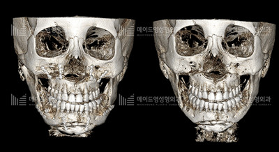 韩国美迪莹轮廓修复CT图