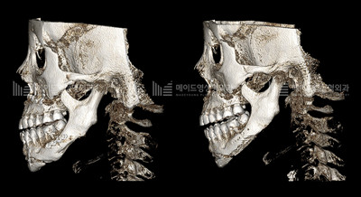韩国美迪莹整形外科轮廓修复好