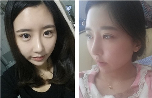 韩国秀美颜双眼皮手术恢复日记