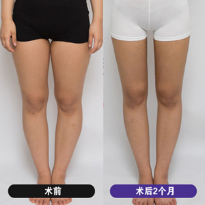 韩国维摩整形外科大腿环吸真人对比图