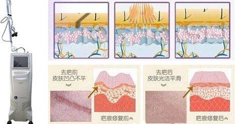 韩国迪美整形外科医院疤痕修复术法展示