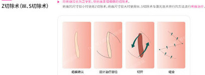 韩国ever整形外科疤痕修复术法展示