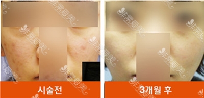 韩国RITZ皮肤科皮肤护理效果图