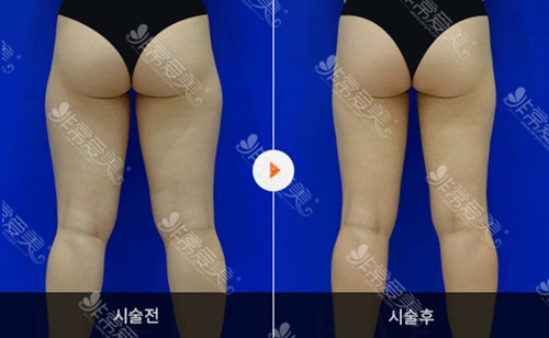 韩国hafis医院腿部吸脂手术图片