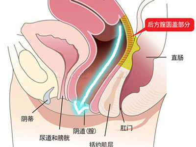 韩国好手艺整形外科后方膣圆盖术法展示图