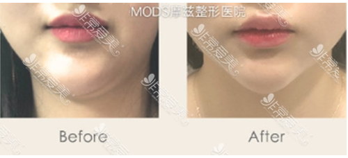 韩国网友热议有名皮肤科管理医院：artline摩兹(MODS)raffine差异