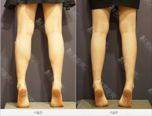 韩国hafis医院吸脂腿部图片分享，吸脂这几个优势值得看！