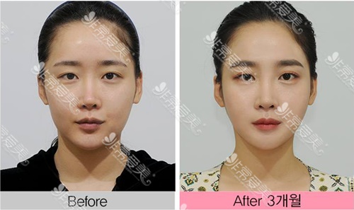 韩国拉菲安拉皮手术对比照片