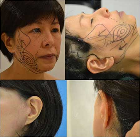 铃木芳郎拉皮手术术前设计以及术后疤痕示意