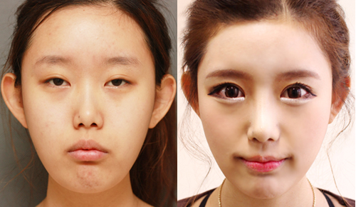 韩国DNA整形外科双眼皮手术案例