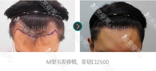 韩国真满毛发医院种植发际线可靠吗