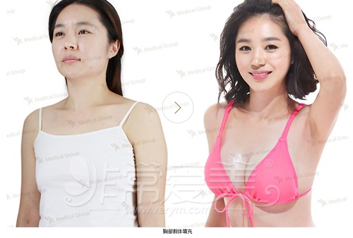 韩国jk整形外科项目费用曝光，擅长隆胸填充脂肪日记动人！