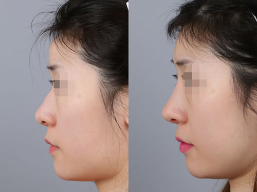 韩国自然主义整形外科驼峰鼻矫正对比案例