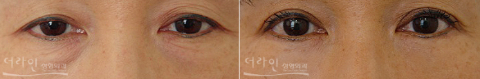 韩国德莱茵医院双眼皮日记对比图