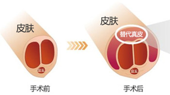 韩国世檀塔男科医院自体真皮增粗阴茎卡通示意图