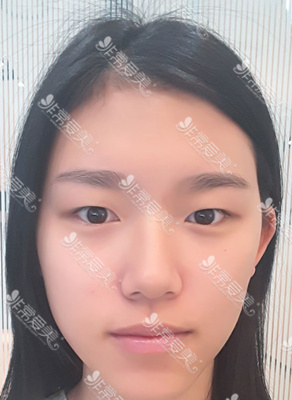 韩国美穗MIHO整形外科做双眼皮好吗