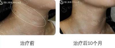 日本圣心医疗美容医院颈纹去除前后对比照片
