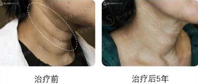 日本圣心医疗美容医院颈纹去除前后对比照片