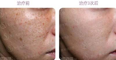 日本圣心医疗美容医院皮肤治疗前后对比案例