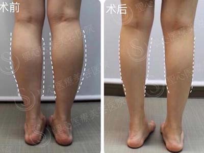 日本圣心医疗美容医院腿部整形案例图
