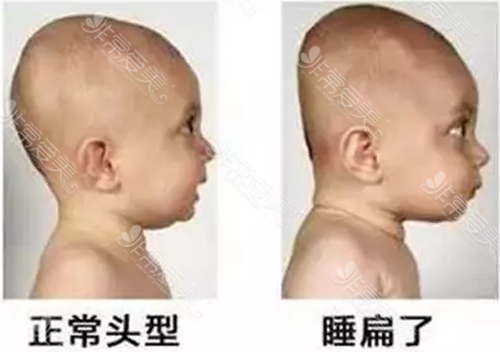 宝宝扁头偏头能矫正吗？婴儿扁头矫正方法有哪些？