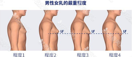 韩国世檀塔男科医院对男性乳房下垂如何手术