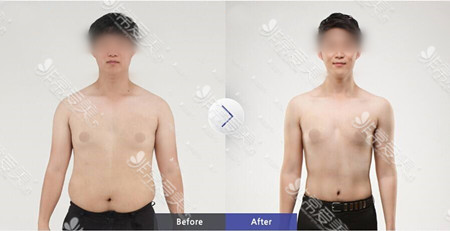 韩国世檀塔男科医院胸部吸脂展示图