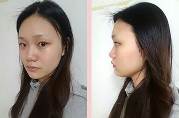 韩国丽丝塔整形外科隆鼻手术效果好不好