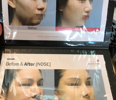 韩国丽丝塔整形外科隆鼻案例实拍图
